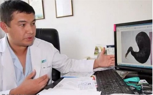 Le encontraron una bola de pelo de nueve libras en su estomago - -- Las2orillas Bahadir Bebezov médico que extrajo la bola de pelos