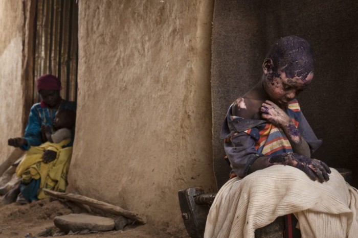 Fotografía ganadora del segundo premio individual en la categoría de problemas contemporáneos, tomada por la fotógrafa Adriane Ohanesian. La imagen muestra a Adam Abdel de 7 años gravemente quemado después de que una bomba lanzada por el gobierno sudanés cayera junto a la casa de su familia en Burgu (Sudán) el 27 de febrero de 2015. ADRIANE OHANESIAN/WORLD PRESS PH (EFE)