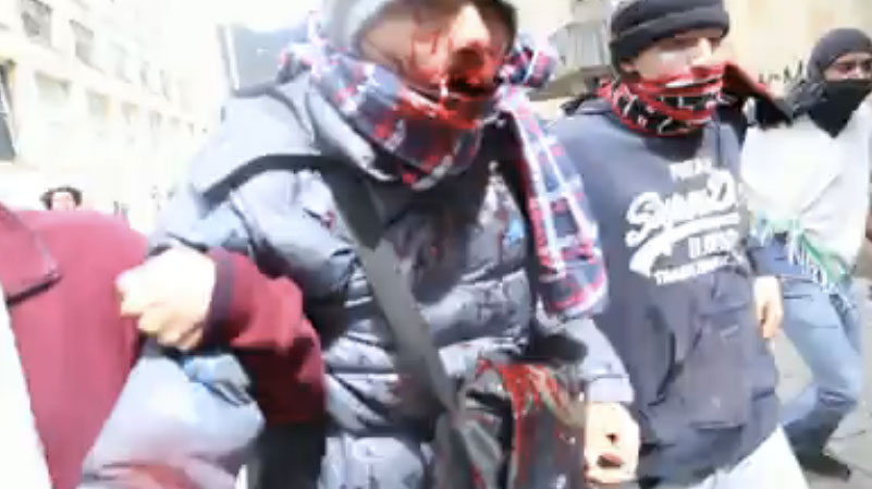 Proyectil lacrimógeno del ESMAD desfigura a joven estudiante