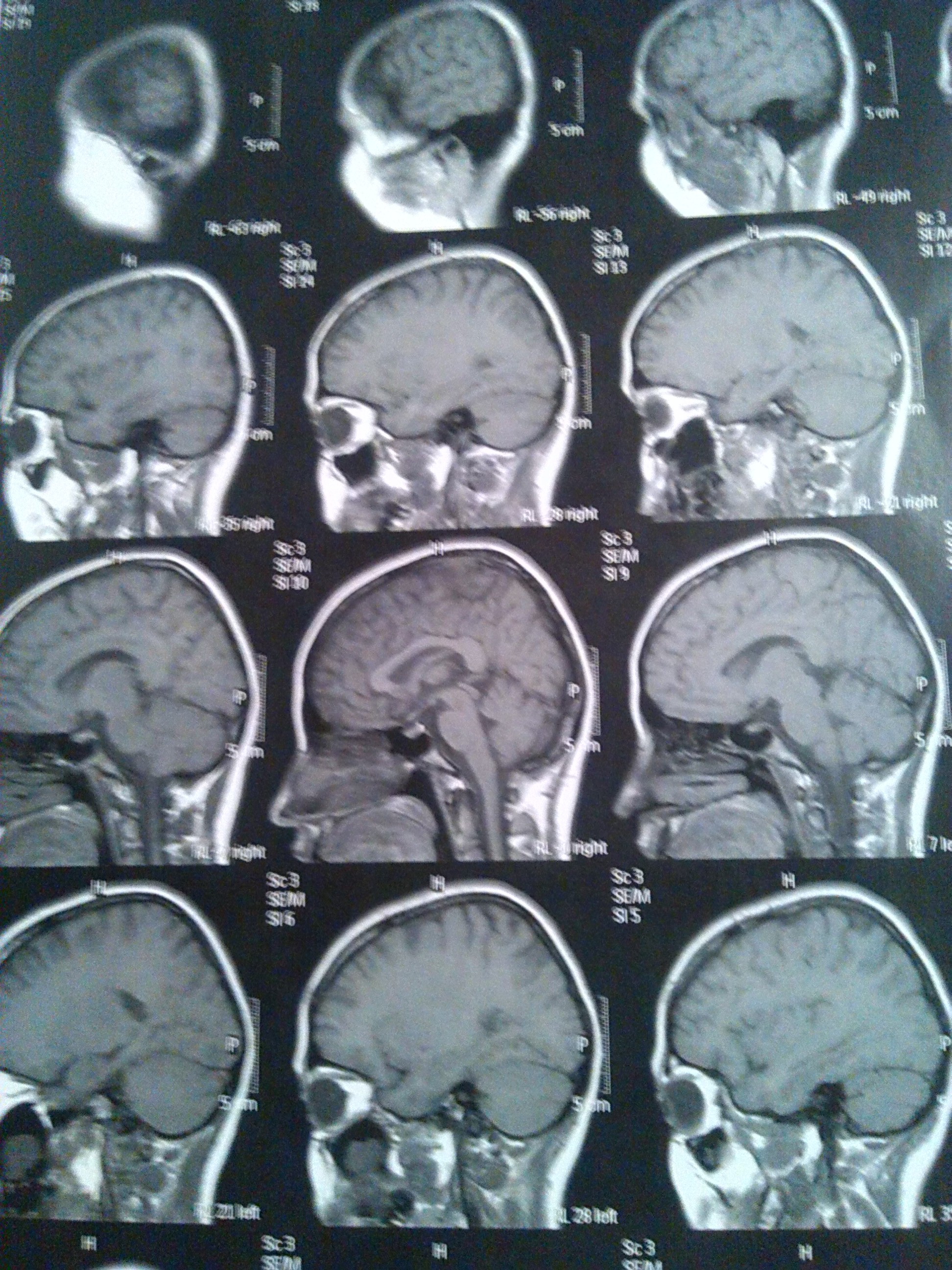 Día Púrpura: rompiendo el estigma sobre la epilepsia