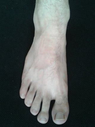 Altos niveles de ácido úrico en la sangre pueden ocasionar graves problemas al organismo