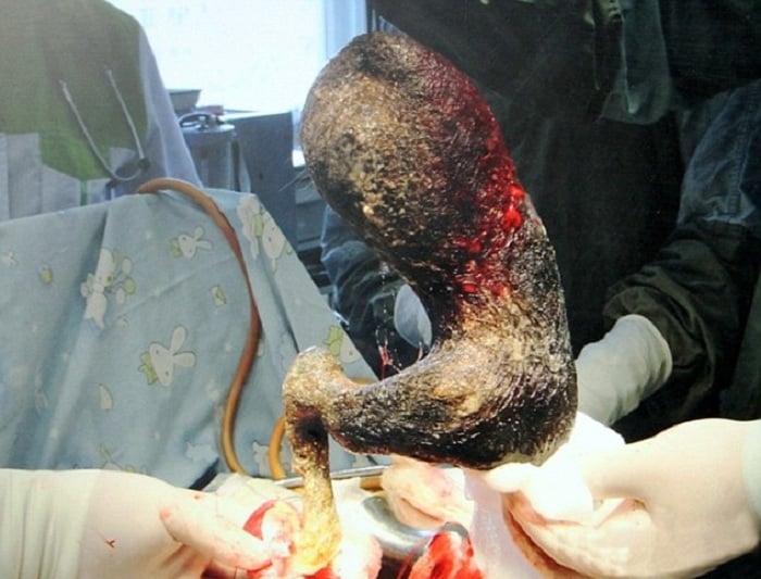 Le encontraron una bola de pelo de nueve libras en su estomago