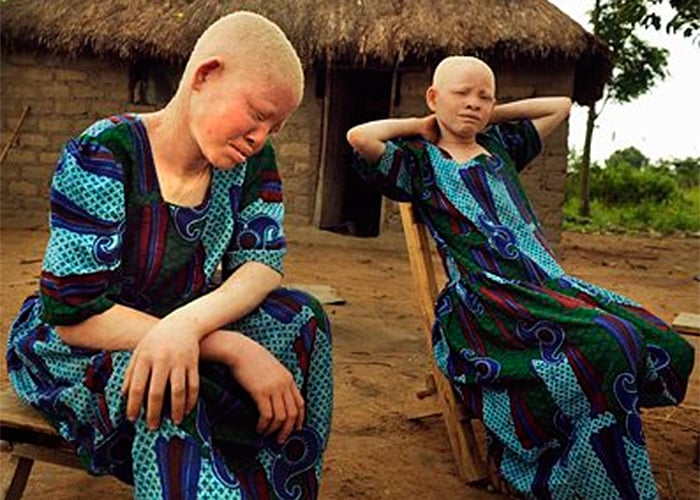 La carnicería albina en África