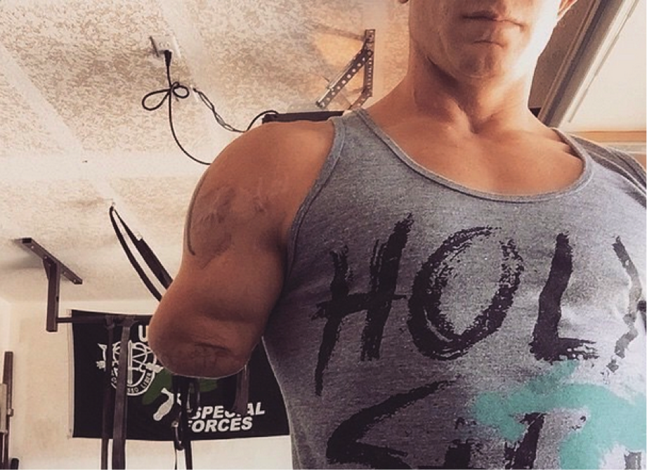 Así es mi vida sin un brazo