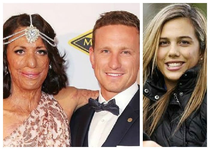 Se quemó el 65 % de su cuerpo y le pidieron matrimonio