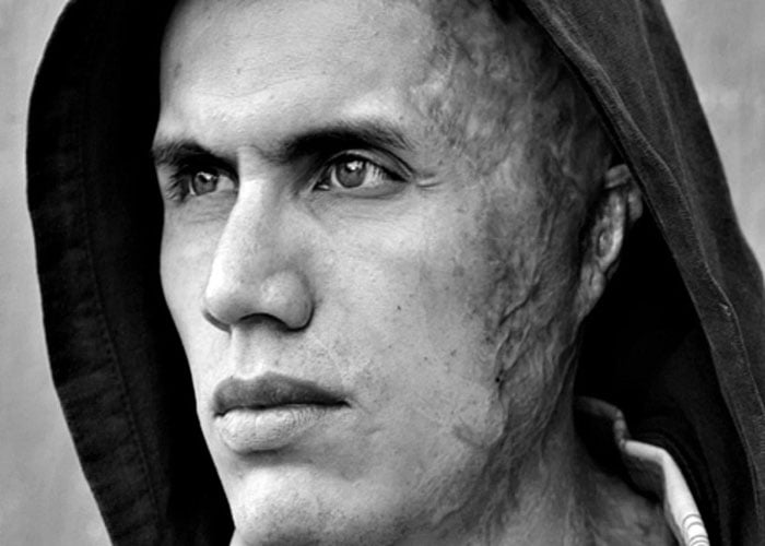 Cuando los hombres sufren ataques con ácido