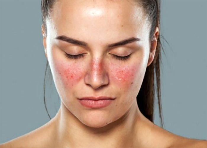 Lupus, la enfermedad grave que muchos ignoran