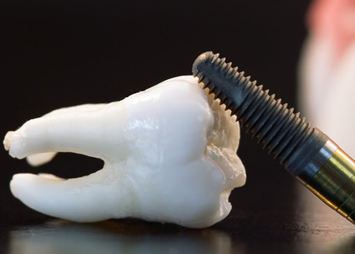 Que su implante dental no se convierta en un dolor de cabeza