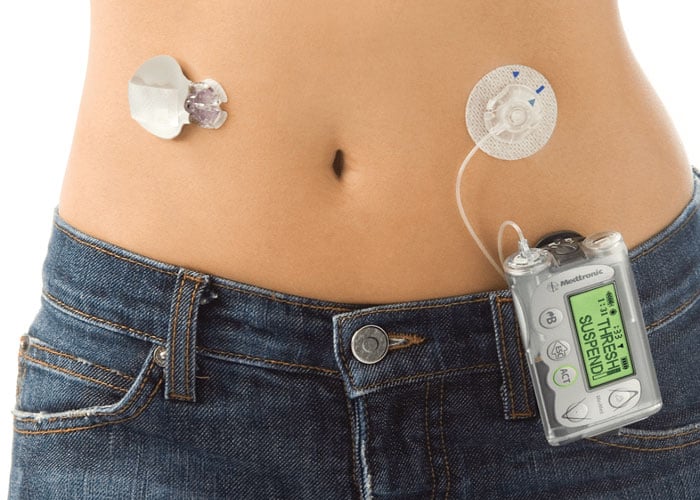 Bomba de insulina, cubierta en el POS