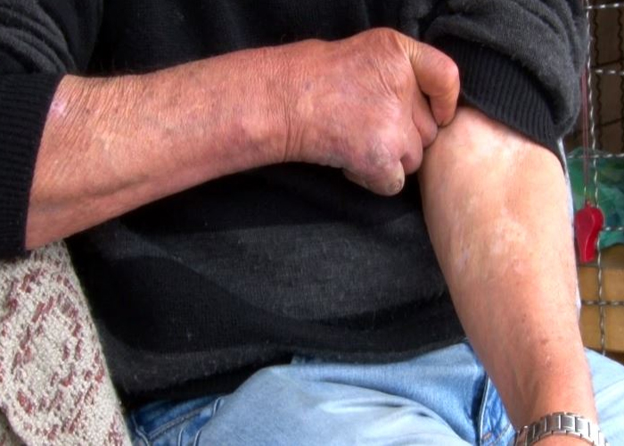 La lepra se niega a desaparecer en el país: se reportan 150 casos en 2018