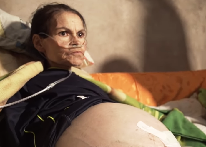 La lucha de Gloria para que le operen su gigante tumor