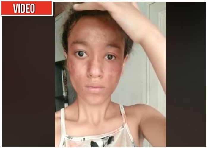 VIDEO: Así le quemó el Esmad la cara a una joven estudiante