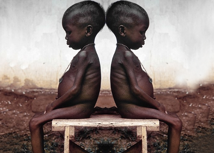 La desnutrición no solo afecta a La Guajira