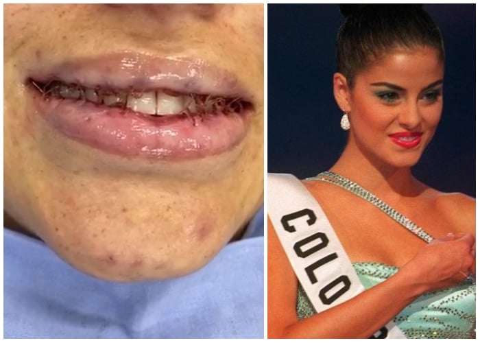 Así quedaron los labios de Catalina Acosta por biopolímeros para Miss Universo