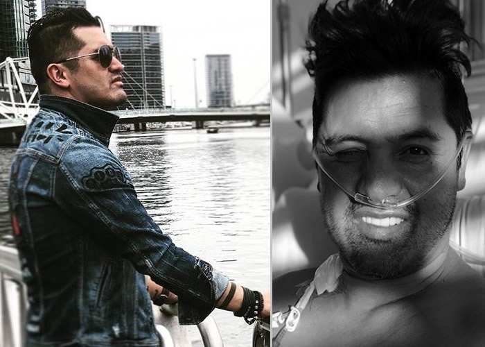 Señales de Hassam después del trasplante