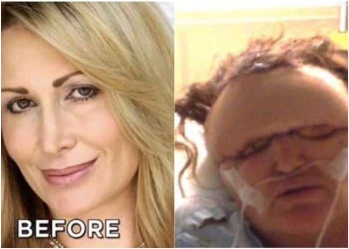 Falso cirujano deforma rostro a modelo tras inyectarle relleno facial