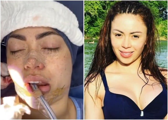 Epa Colombia muestra cómo quedó después de 5 cirugías en rostro