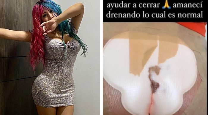  - [VIDEO] A Yina Calderón se le abrieron los puntos tras cirugía de cola