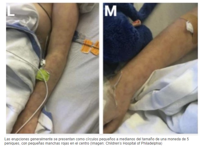  - Pilas: estas erupciones en los niños podrían ser COVID 19