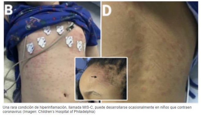  - Pilas: estas erupciones en los niños podrían ser COVID 19