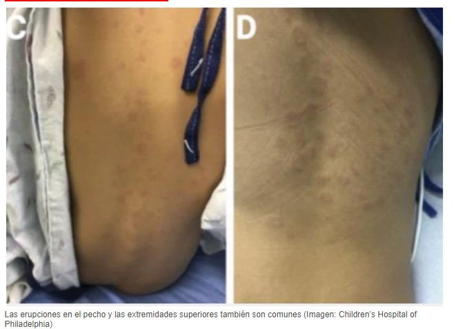  - Pilas: estas erupciones en los niños podrían ser COVID 19