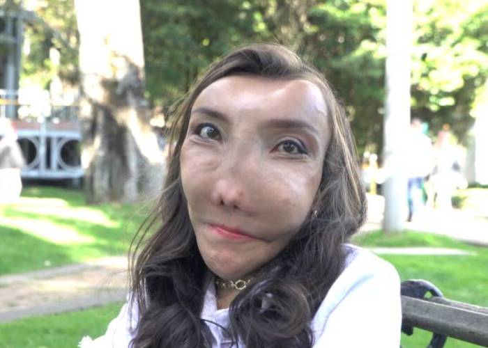 VIDEO: Una enfermedad que le deformó el rostro