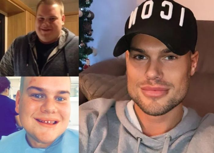 Adicto a la cirugías: gastó más de 130 millones de pesos para verse perfecto