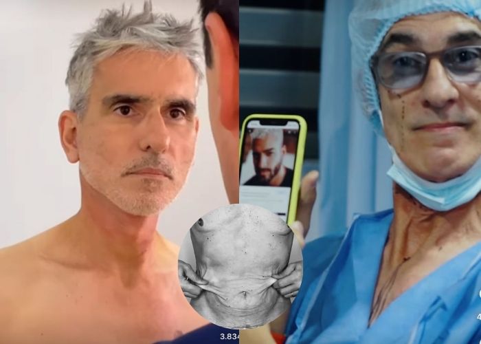 ¿Luce como Maluma? Así quedó Miguel Varoni después de operarse