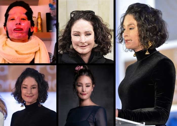 Ácido, un rostro destruido y 37 cirugías: Natalia Ponce, invencible