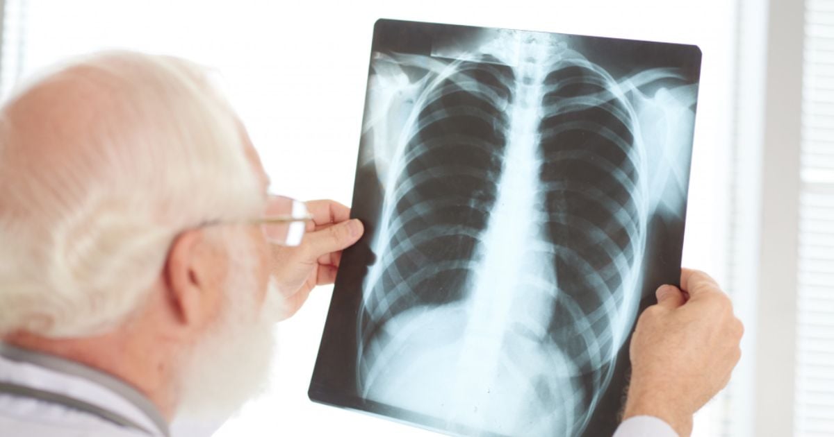 Padecer cáncer de pulmón y enterarse demasiado tarde