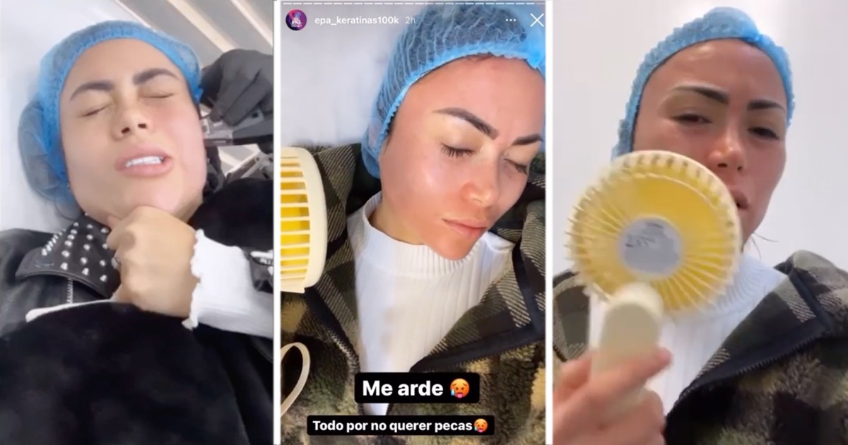 Se quemó la cara por quitarse las pecas: la última imbecilidad de Epa Colombia