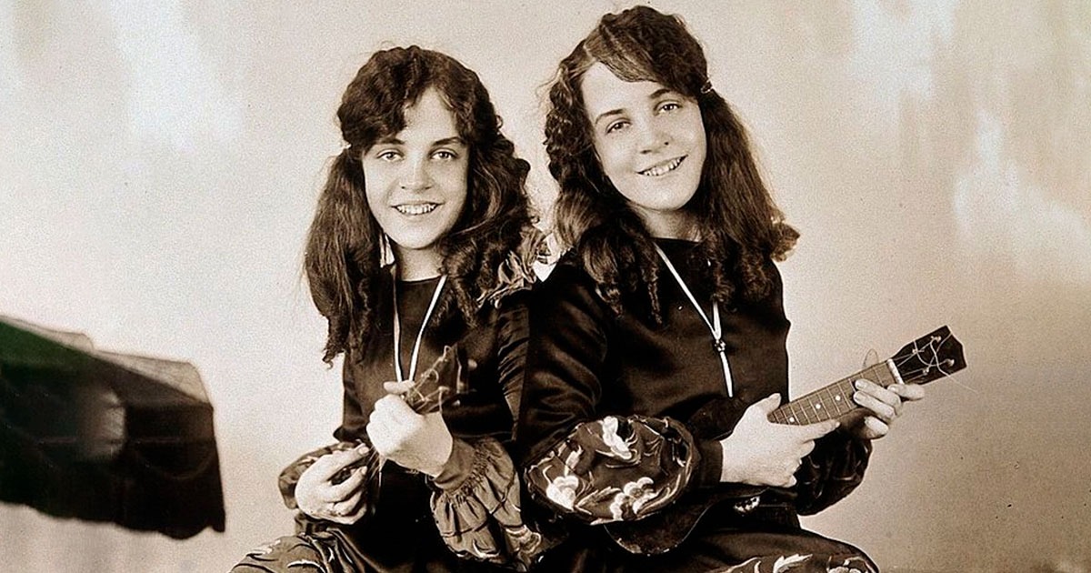 El grave problema para un médico de separar a unas siamesas